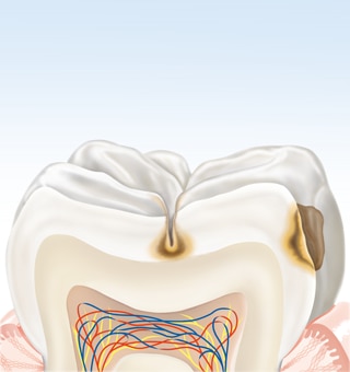 about-karies-tooth2-de.png about-karies-tooth2-de.png