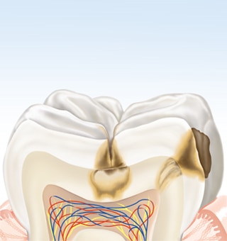 about-karies-tooth3-de.png about-karies-tooth3-de.png